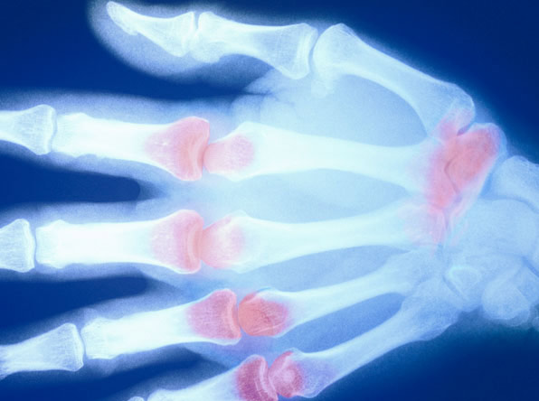 Inflammation hand