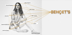 Behçet disease