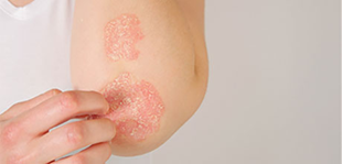 psoriasis