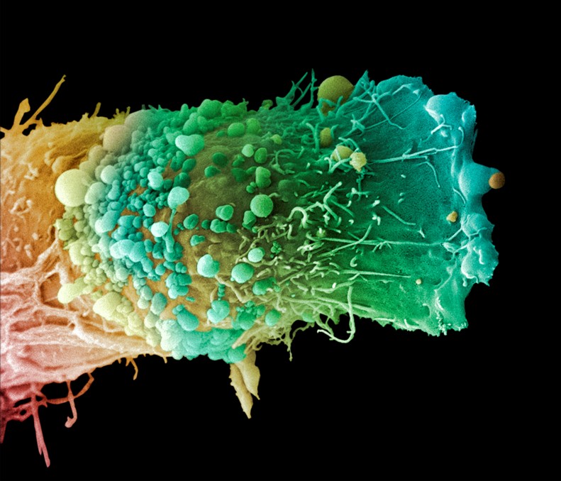 Skin cancer cell