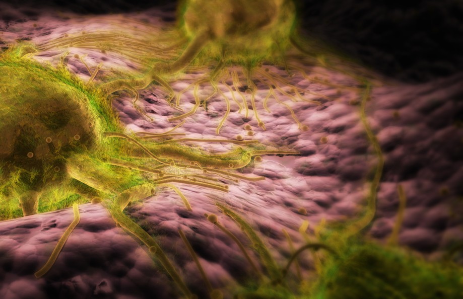 Breast cancer cells on the surface of breast tissue