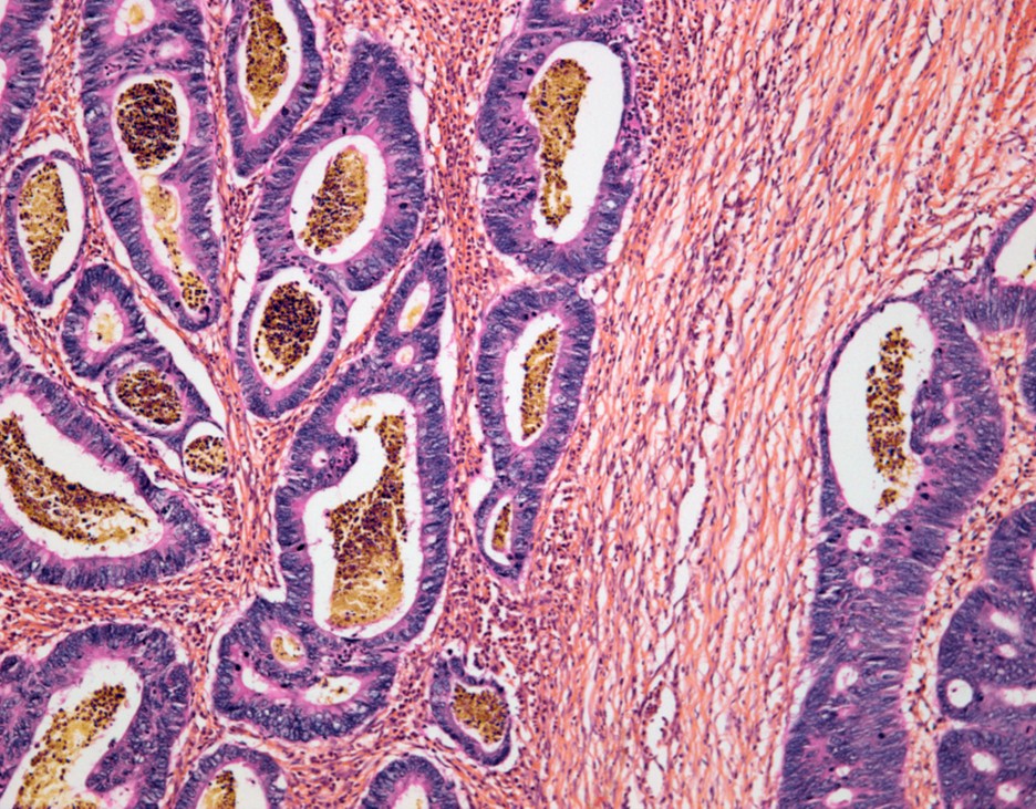 Colon cancer, light micrograph